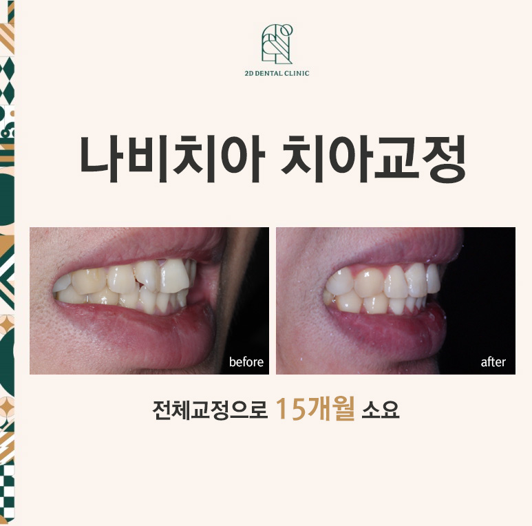 나비치아교정! 15개월만에 빠른 교정 by.투디치과(2D치과) 관련 이미지 1