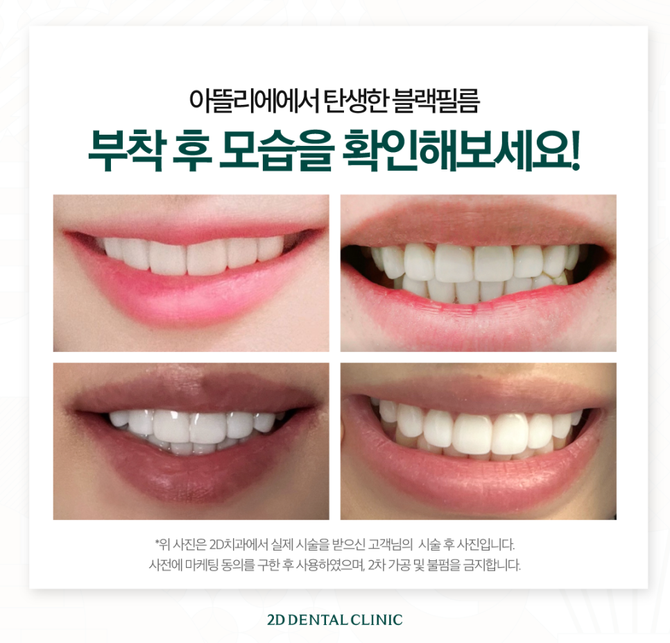 치아무삭제라미네이트 블랙필름 정교한 손끝에서 만들어집니다 관련 이미지 6