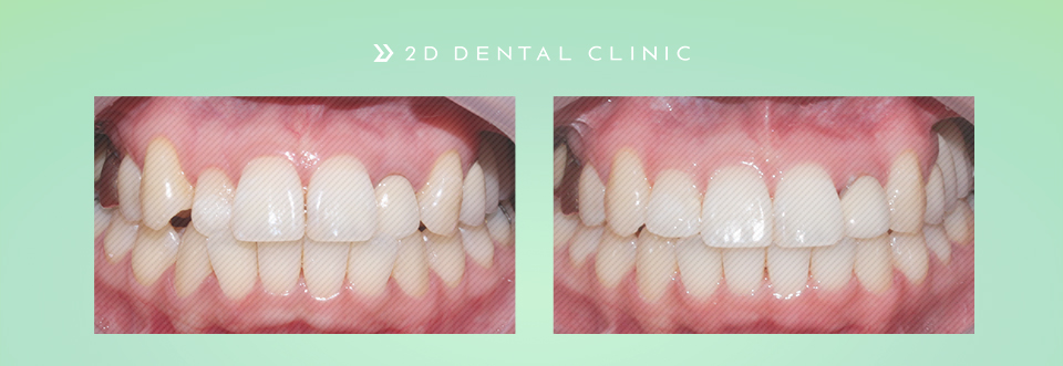 케이스로 확인하는 덧니 부정교합, 교정전문 2D치과 관련 이미지 1