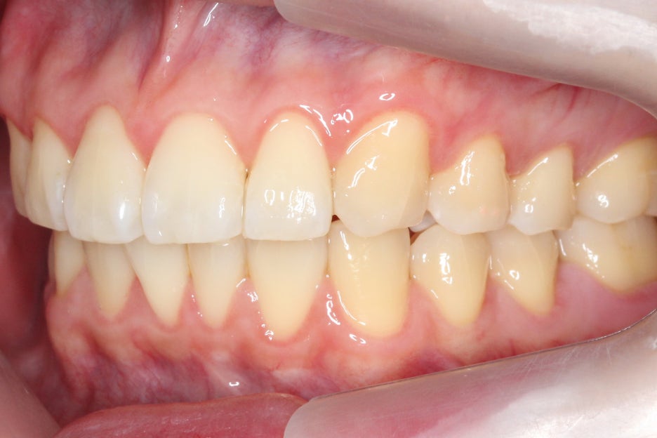 논현동치과 윗니부분교정 후기 관련 이미지 11