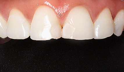 앞니왜소치 치아깨짐 무삭제라미네이트 블랙필름 관련 이미지 4