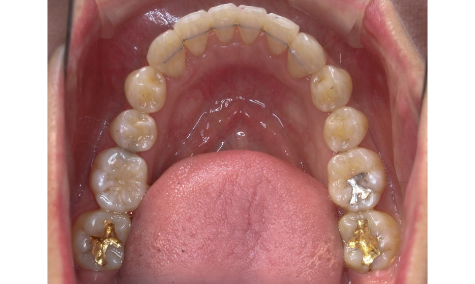 입툭튀 교정 신논현역치과 전체교정으로 관련 이미지 14