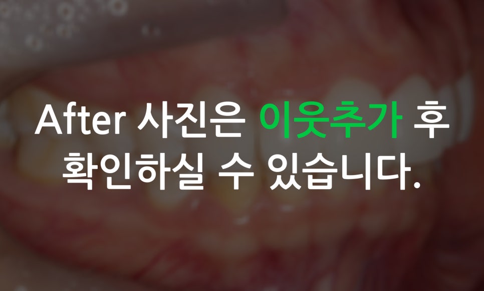 송곳니덧니 교정과 왜소치 세라필름을 한번에! 관련 이미지 10