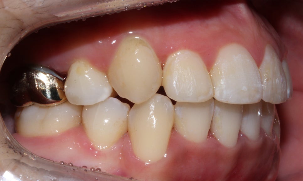 crowding 송곳니덧니 세라믹교정 방법 관련 이미지 11