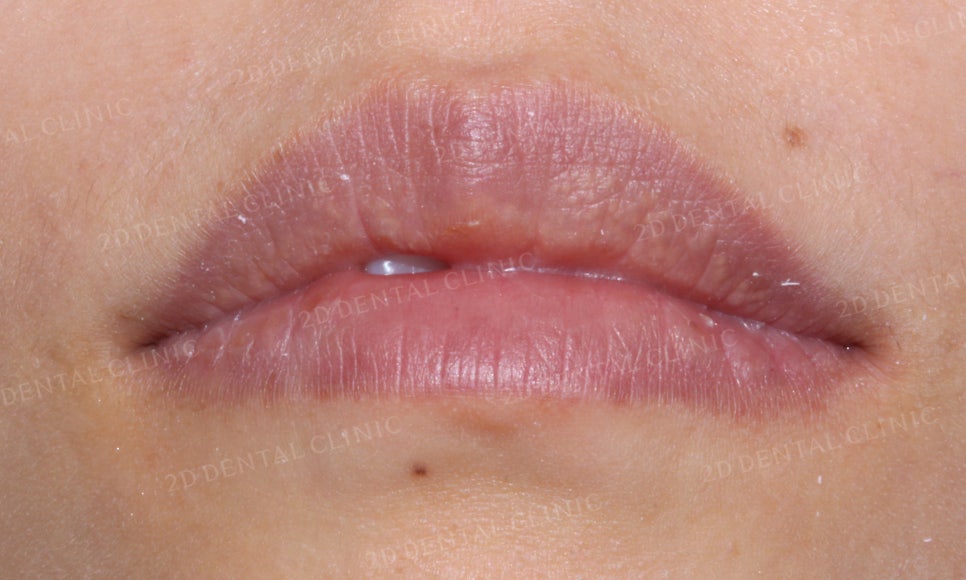 [2D교정] 나비치아, 앞니교정 설측교정으로 빠르게 하는 방법! by.2D치과(투디치과) 관련 이미지 2