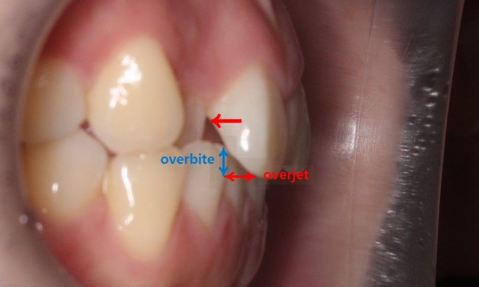 덧니교정 2D교정 (부분교정) 후기 관련 이미지 2