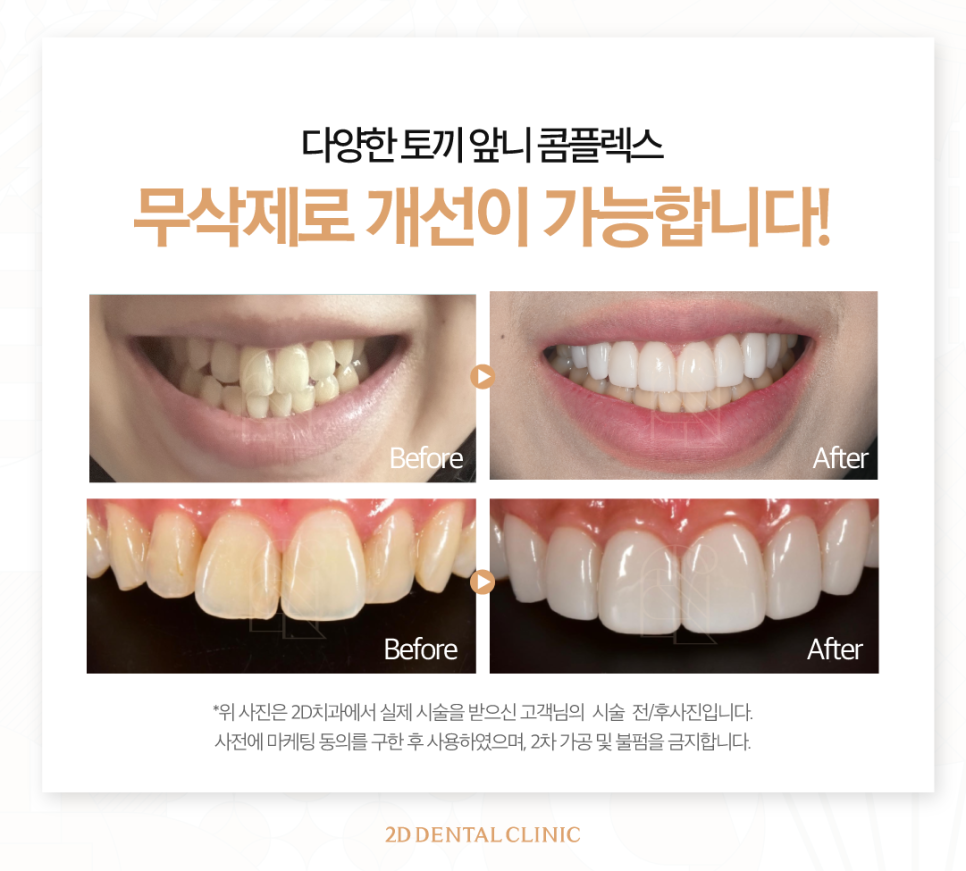 토끼이빨라미네이트 앞니성형으로 단정하고 우아하게 관련 이미지 6