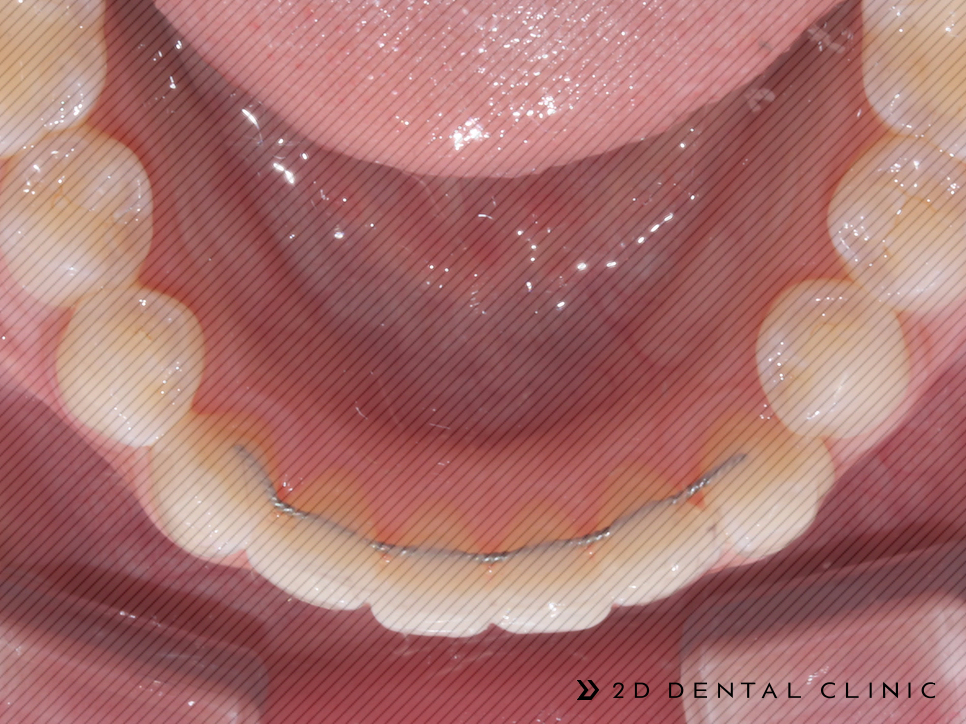 앞니 덧니 부분교정 케이스 전후비교, 교정전문 2D치과 관련 이미지 13