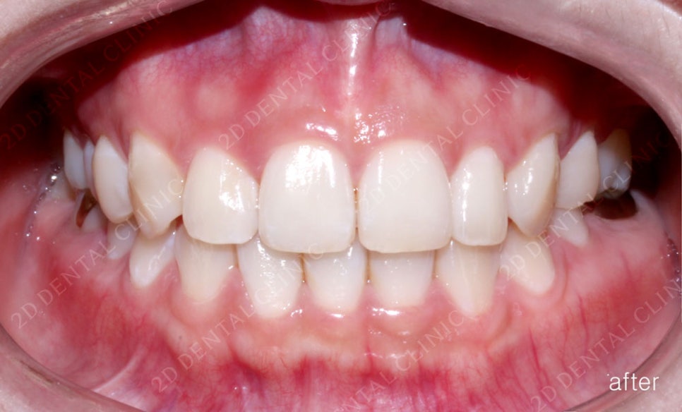 토끼이빨 치아교정 치료 사례 관련 이미지 6