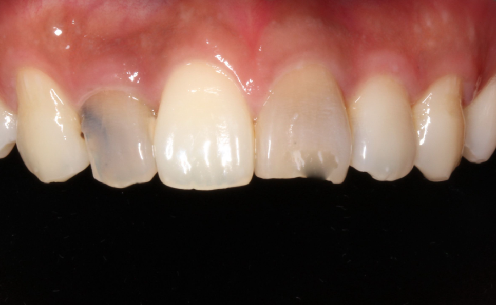 앞니깨짐 라미네이트로 자연스럽게! 관련 이미지 1