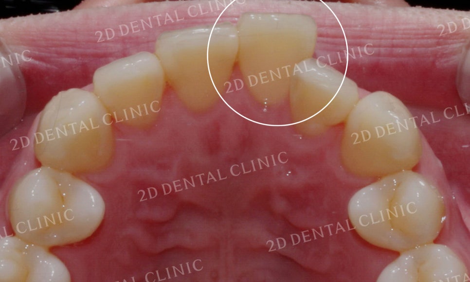 [투디교정] 부정교합 앞니교정을 투디교정으로 고르게! by.투디치과(2D치과) 관련 이미지 15