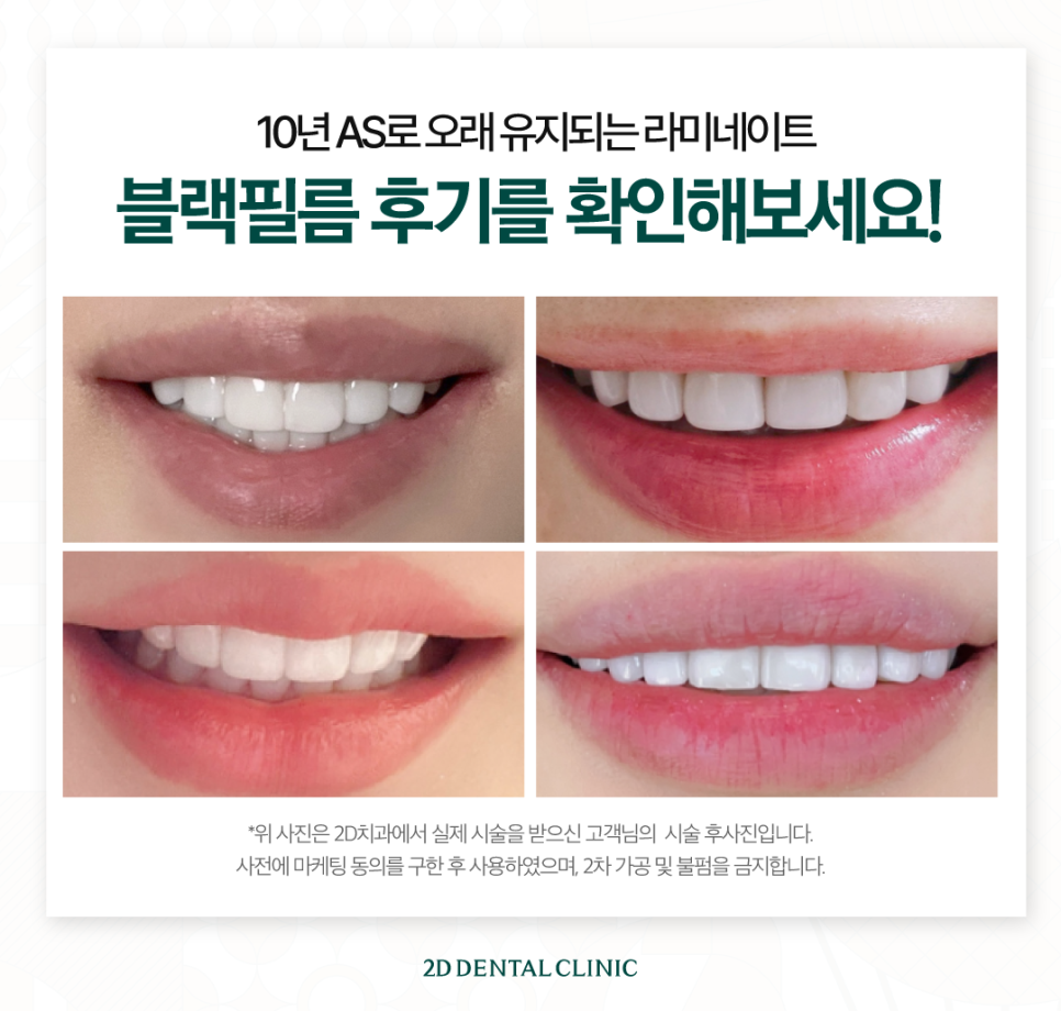 무삭제라미네이트부작용 치아부분변색 얼룩진 앞니 개선 관련 이미지 7