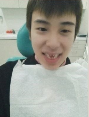 연예인 시술 치아 무삭제라미네이트 2D치과의 독자적인 블랙필름 관련 이미지 4