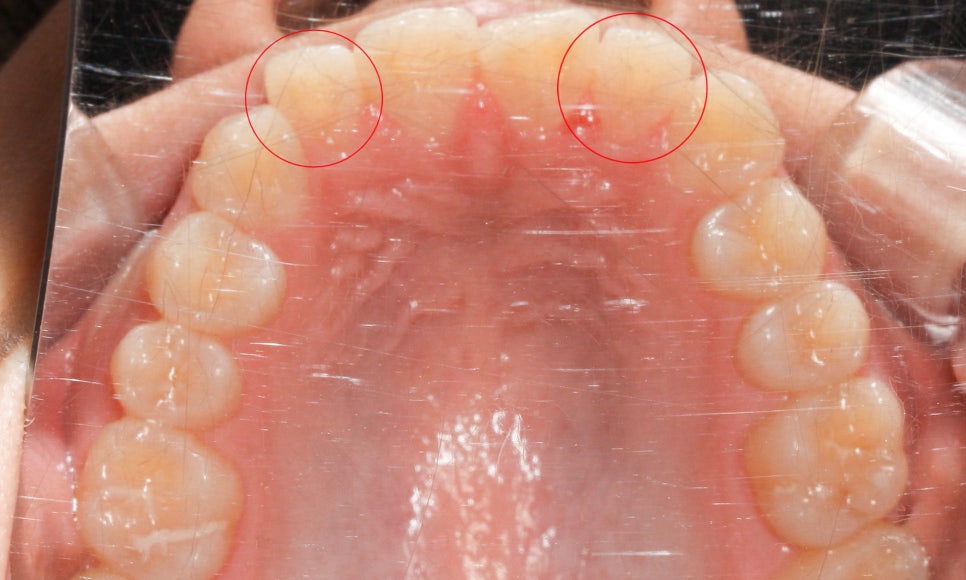 톱니모양 치아를 매끄러운 치아모양으로 개선하는 방법! (마멜론치아) 관련 이미지 4