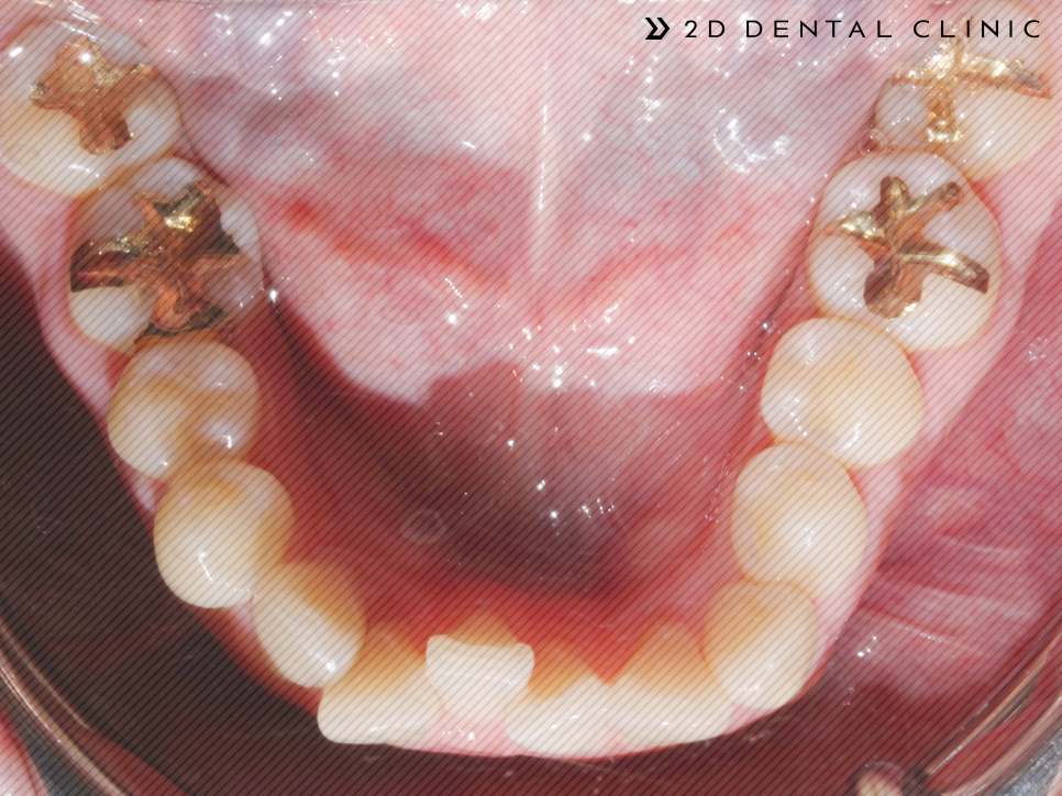 발치교정 돌출입 케이스, 교정전문 2D치과 관련 이미지 11