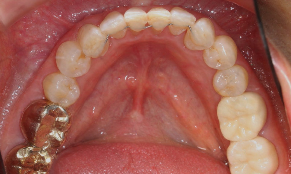 2D교정으로 아랫니 부분교정 빠르게 완성하기! 관련 이미지 10