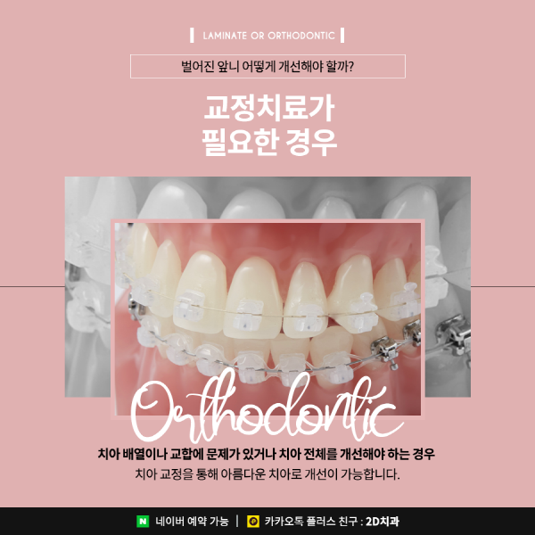 벌어진앞니는 라미네이트? 치아교정? 이렇게 선택하세요 관련 이미지 5