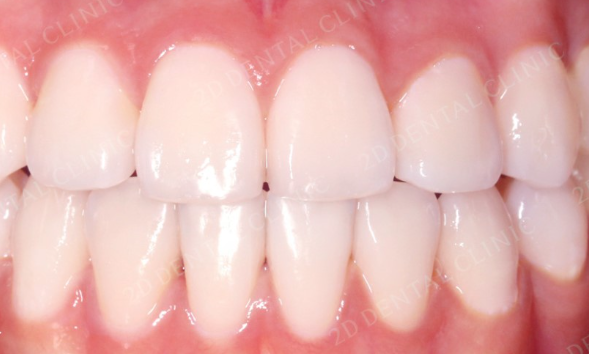 연예인라미네이트 블랙필름 무삭제라미네이트가격 관련 이미지 2