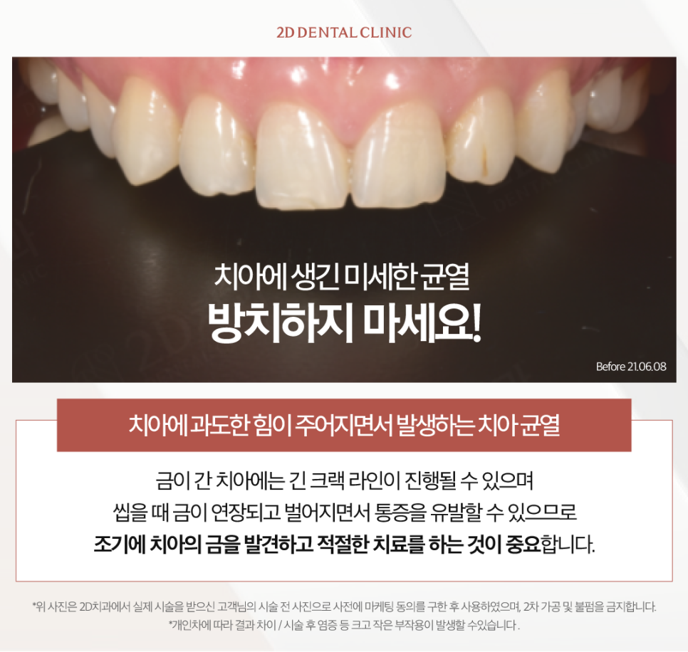 창원무삭제라미네이트 치아균열 이에 생긴 금, 어떻게 해야 할까? 관련 이미지 3