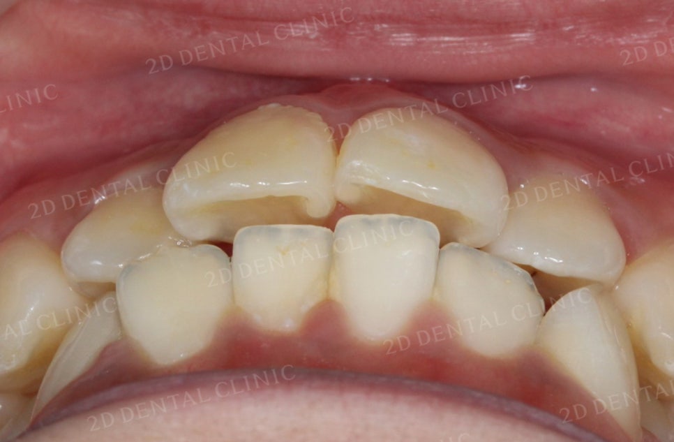 [앞니교정] 토끼앞니교정, 클리피씨 교정으로 완벽하게! by.투디치과(2D치과) 관련 이미지 3