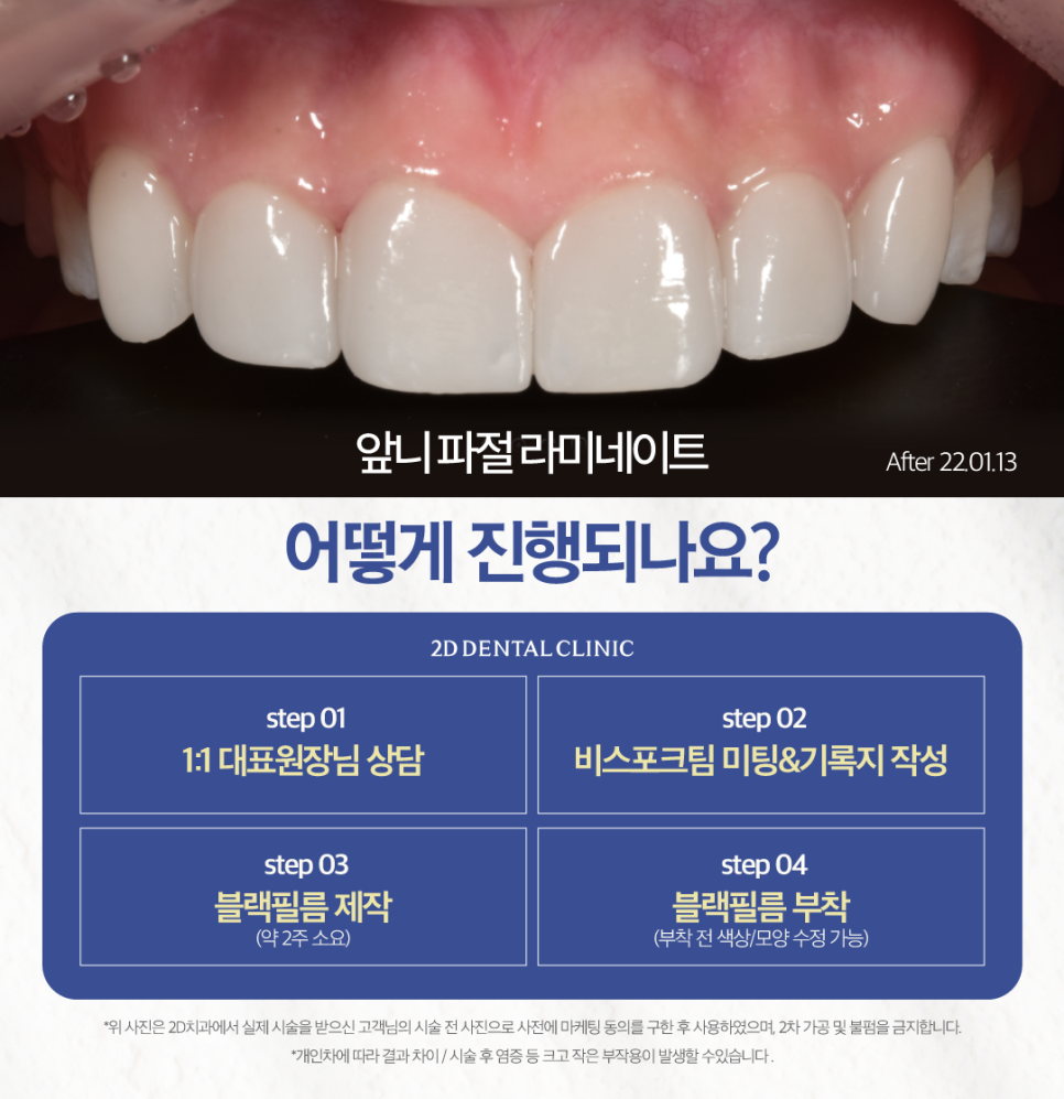 무삭제라미네이트가격 치아파절치료 깨진 이 개선 방법은? 관련 이미지 4