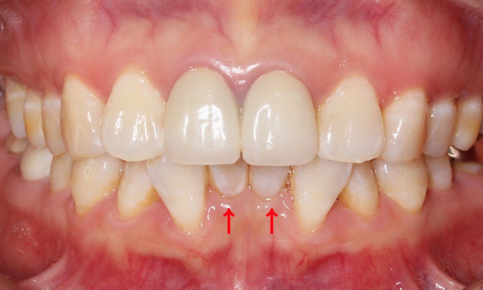2D교정으로 아랫니 부분교정 빠르게 완성하기! 관련 이미지 5
