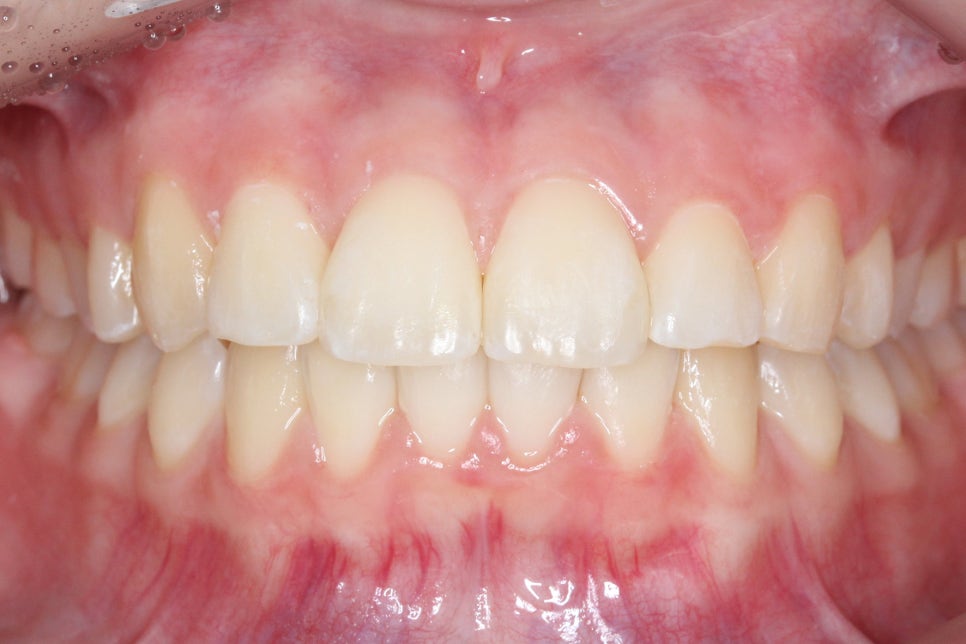 투디치과 송곳니덧니 치료 후기 관련 이미지 8