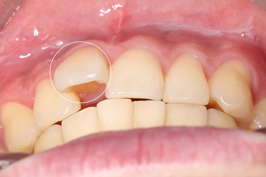 논현동치과 윗니부분교정 후기 관련 이미지 2