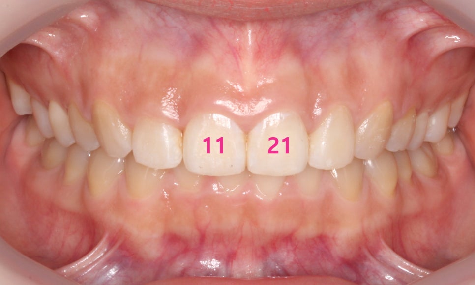 나비치아교정, 부분 치아교정으로 하고 싶다면? by.투디치과(2D치과) 관련 이미지 12