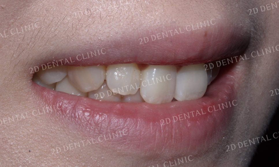 나비치아교정, 부분교정으로 나비치아 탈출하기! by.투디치과(2D치과) 관련 이미지 12