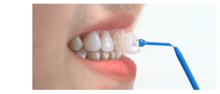 라미네이트 치료 전 체크해야할 부분은? 관련 이미지 13