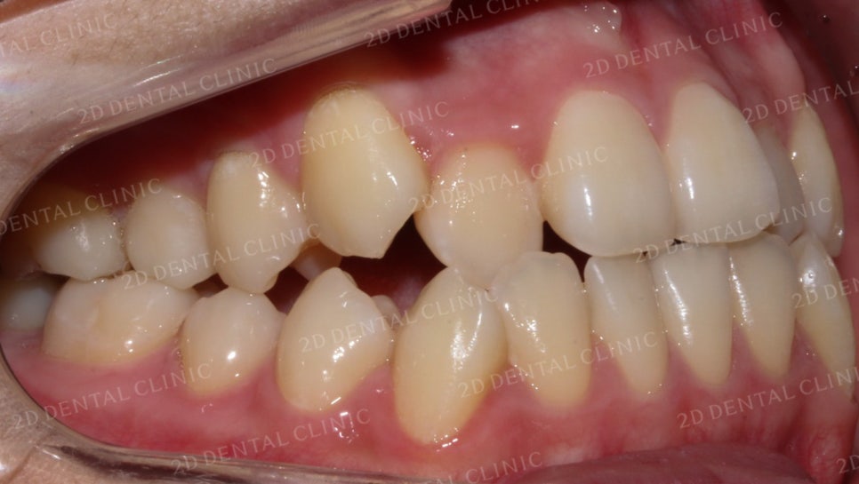 덧니치아교정, 클리피씨 전체교정으로 완벽하게! by.투디치과(2D치과) 관련 이미지 4