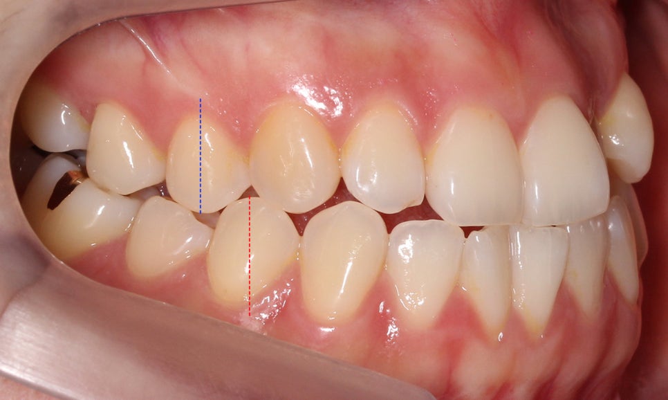 절단교합 클리피씨 교정 방법 관련 이미지 4