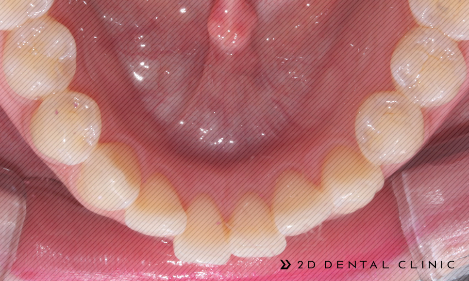 앞니 덧니 부분교정 케이스 전후비교, 교정전문 2D치과 관련 이미지 12