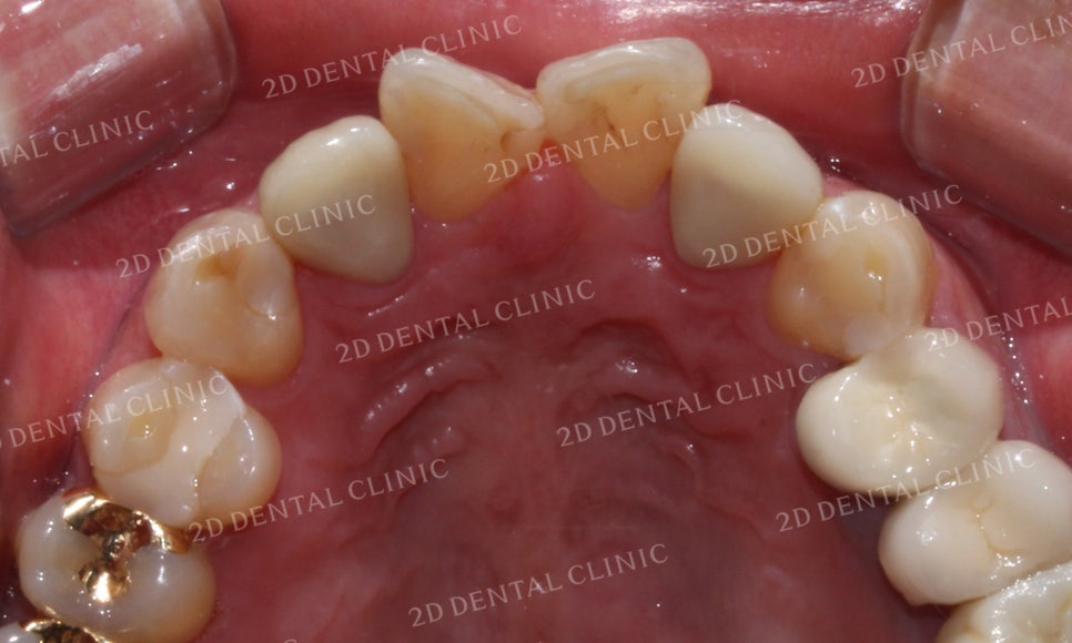 [2D교정] 나비치아교정을 2D교정 장치로 빠르게 완성하기! by.2D치과(투디치과) 관련 이미지 15