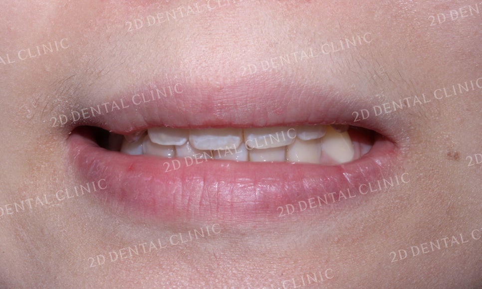 나비치아교정, 부분교정으로 나비치아 탈출하기! by.투디치과(2D치과) 관련 이미지 11