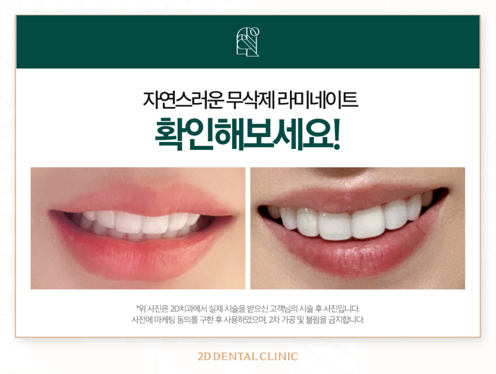 무삭제라미네이트부작용 2D치과블랙필름 A to Z 관련 이미지 9