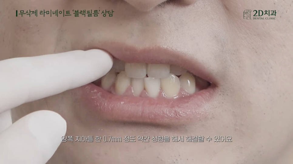 [블랙필름 상담받고 왔어요] #2 반대교합도 가능할까요? 관련 이미지 14