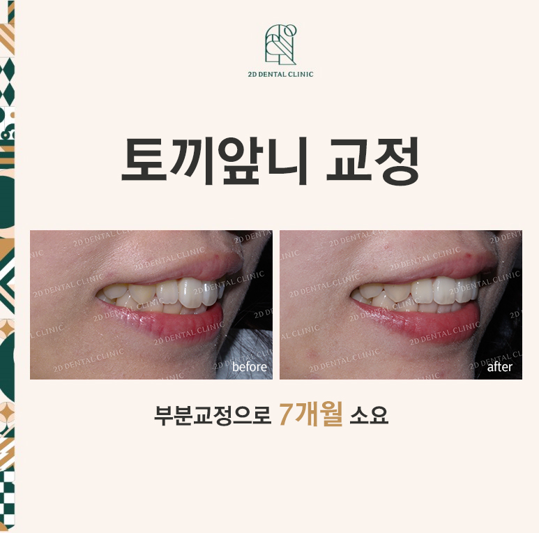 [앞니교정]토끼앞니교정, 부분교정으로 토끼이빨 탈출하기! by.투디치과(2D치과) 관련 이미지 1