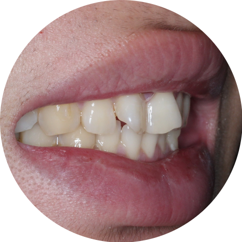 나비치아교정! 15개월만에 빠른 교정 by.투디치과(2D치과) 관련 이미지 2