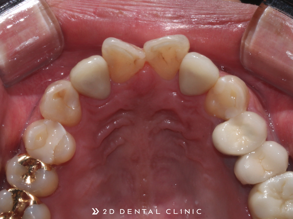 나비치아, 앞니 부분 2D교정으로 교정 기간 단축! 관련 이미지 12