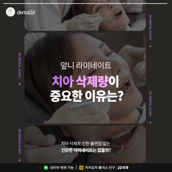 "다시 복구 못해요" 앞니라미네이트 치아 삭제량이 중요한 이유 관련 이미지 1
