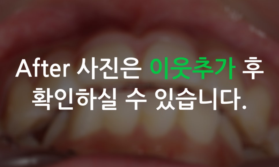 세라믹교정 앞니틀어짐 교정 사례 관련 이미지 13