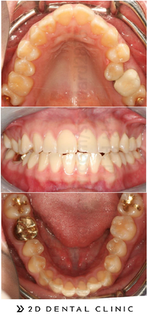 돌출입 유형 및 증상, 치과 내원 전 자가진단! 관련 이미지 6