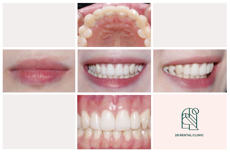 덧니치아 앞니교정 4개월 교정 완료! by. 투디치과(2D치과) 관련 이미지 8
