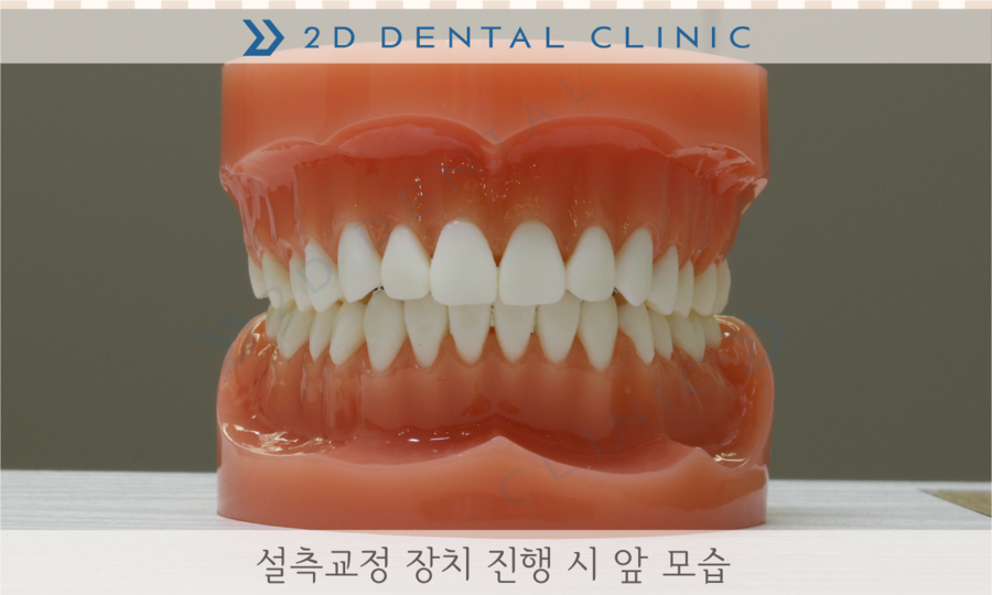[교정상식] 설측교정,투명교정,콤비교정 장치종류 및 장단점! 관련 이미지 5