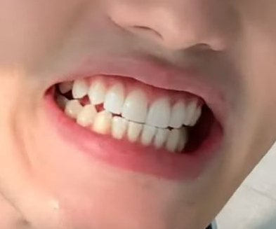 치과의사도 한 쎄라필름 유튜버 오대리Oderi님 리얼 후기! by.2D치과(투디치과) 관련 이미지 18
