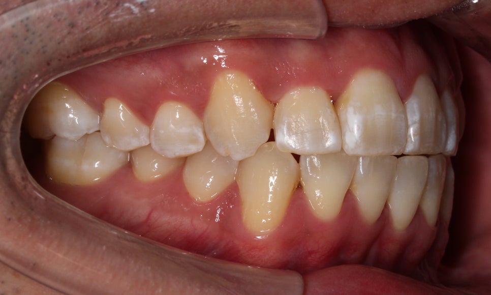앞니 덧니 고민, 부분 설측 교정으로 해결한 사례 관련 이미지 11