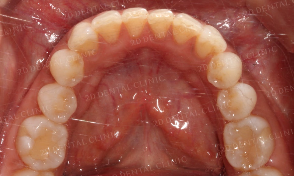 [부분교정] 틀어진 앞니, 부분교정으로 앞니교정하기! by.투디치과(2D치과) 관련 이미지 21