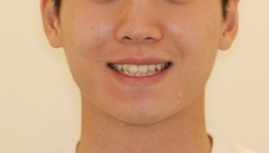 부분교정으로 삐뚤어진 앞니 예뻐지는 방법 관련 이미지 4